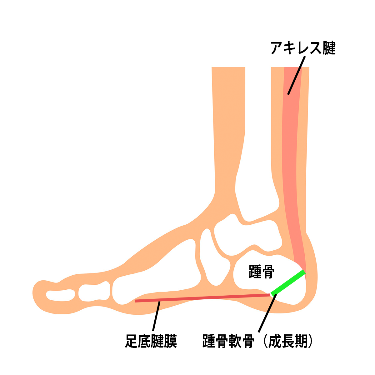 イラスト：踵骨骨端症(セーバー病、シーバー病)