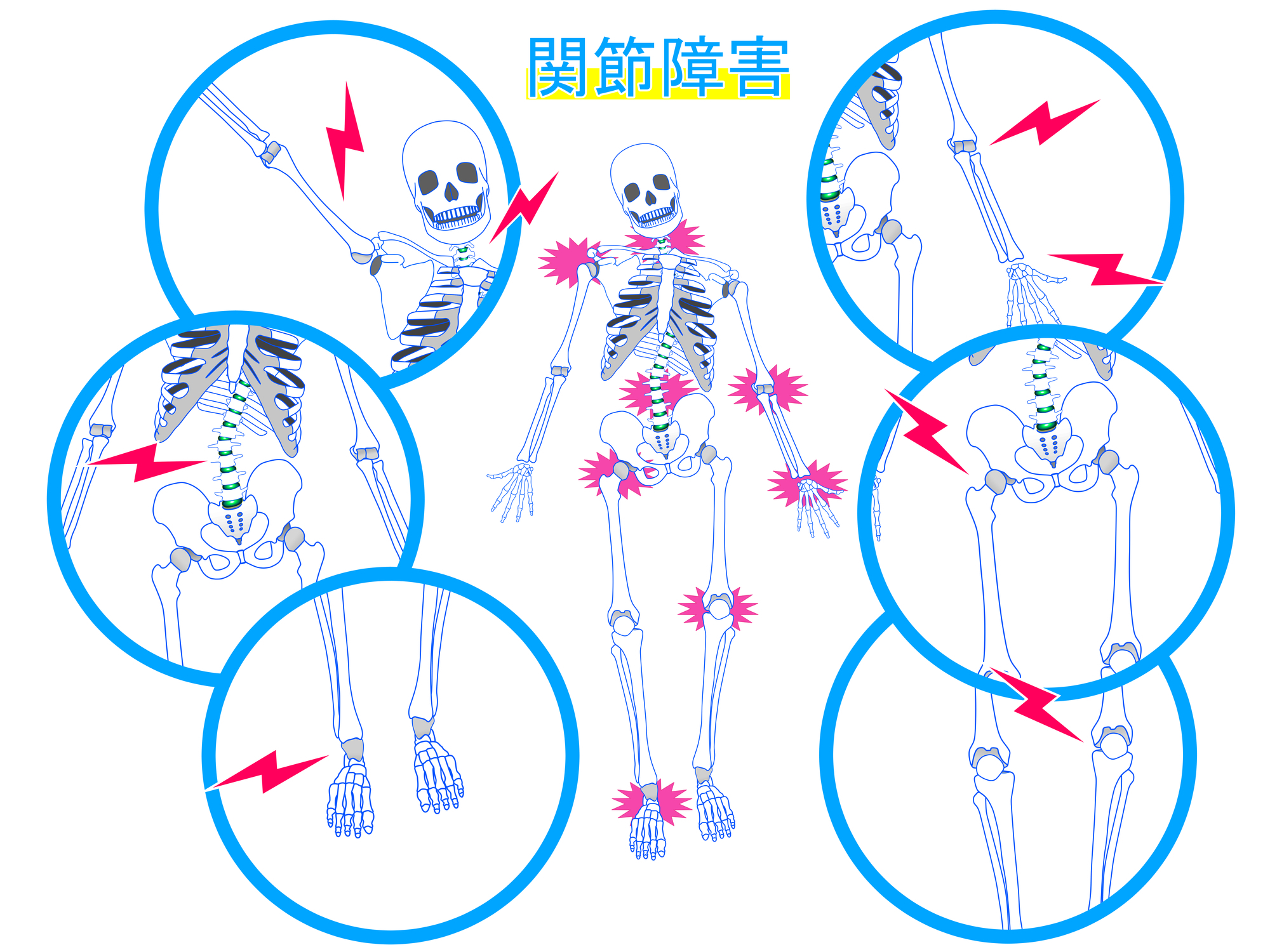 イラスト：関節障害